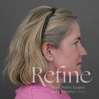 Deep Neck Lift Before & After Gallery - Patient 420466 - Image 2