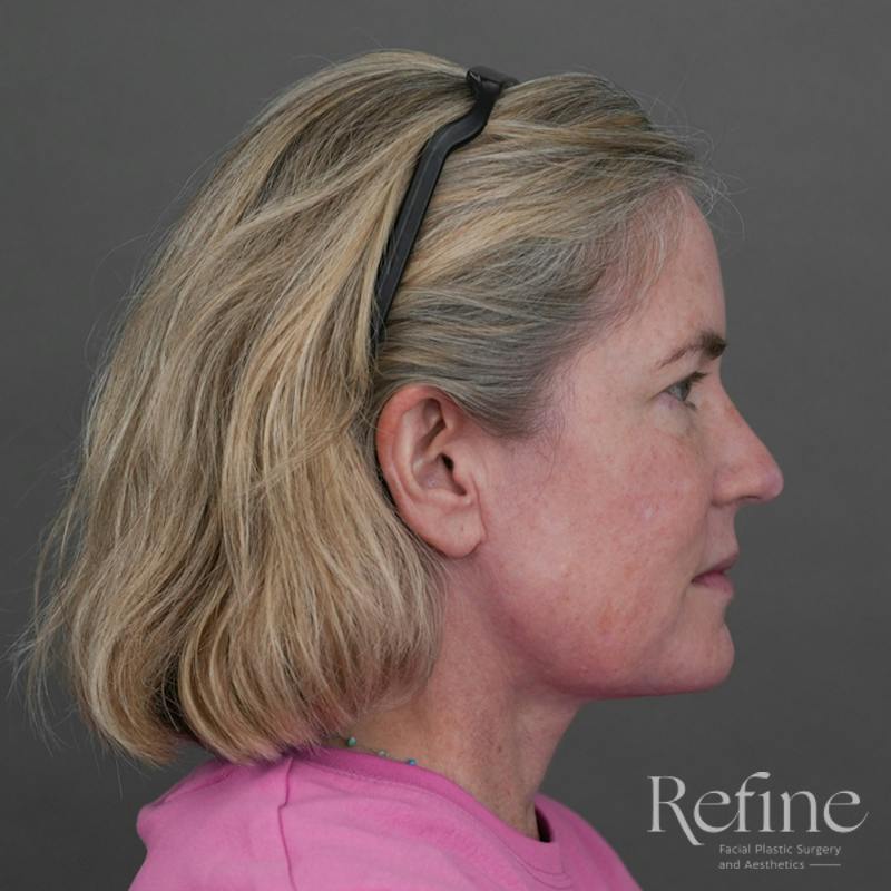 Deep Neck Lift Before & After Gallery - Patient 420466 - Image 2
