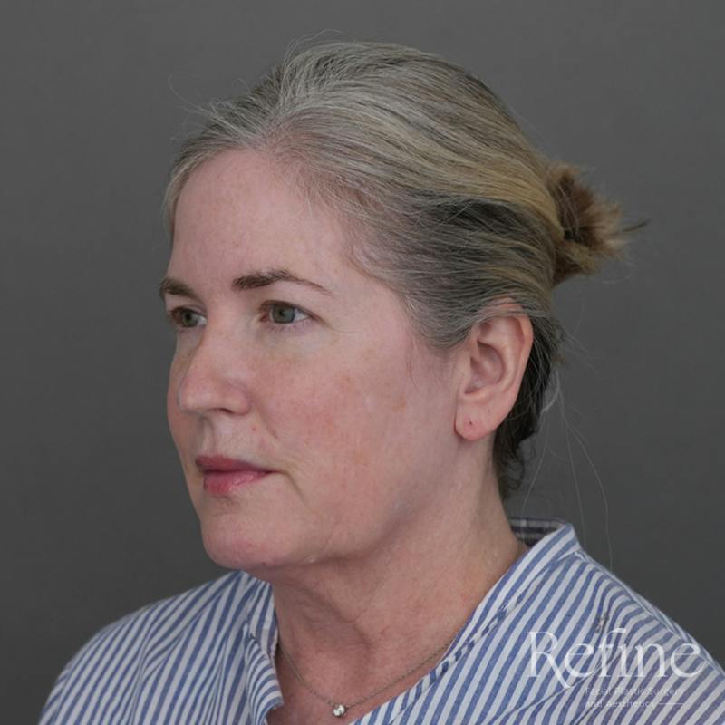 Deep Neck Lift Before & After Gallery - Patient 420466 - Image 7