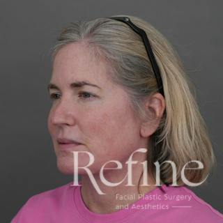 Deep Neck Lift Before & After Gallery - Patient 420466 - Image 8