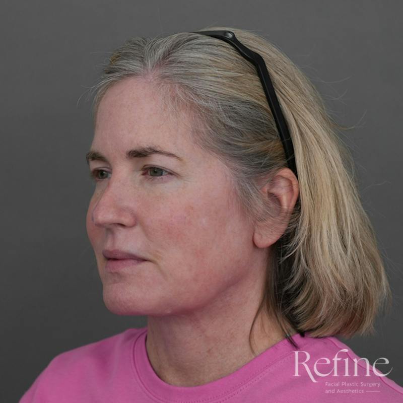 Deep Neck Lift Before & After Gallery - Patient 420466 - Image 8