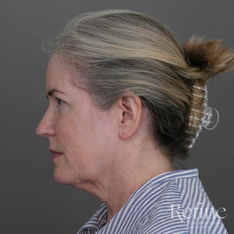 Deep Neck Lift Before & After Gallery - Patient 420466 - Image 9