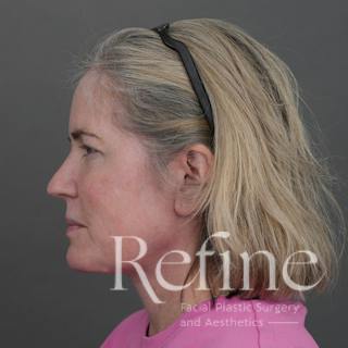 Deep Neck Lift Before & After Gallery - Patient 420466 - Image 10