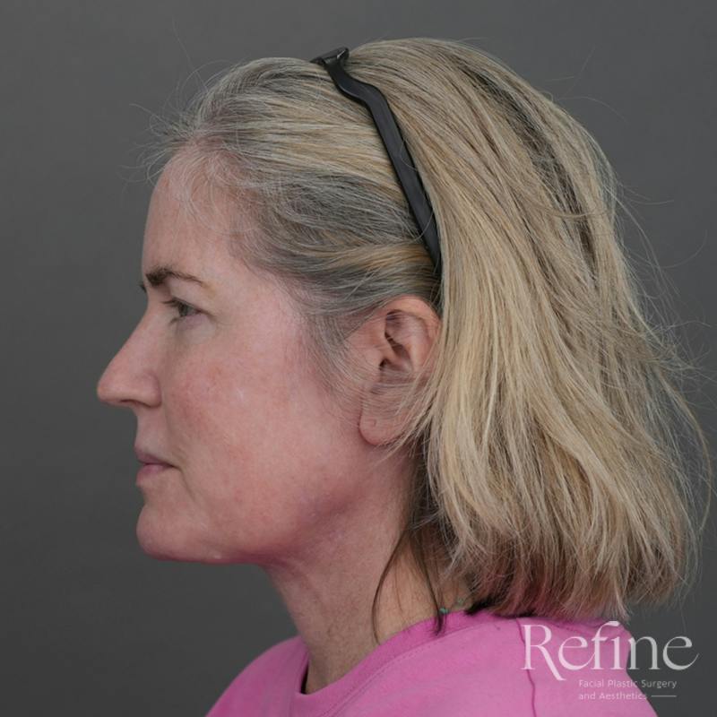 Deep Neck Lift Before & After Gallery - Patient 420466 - Image 10