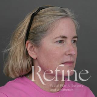 Deep Neck Lift Before & After Gallery - Patient 420466 - Image 4