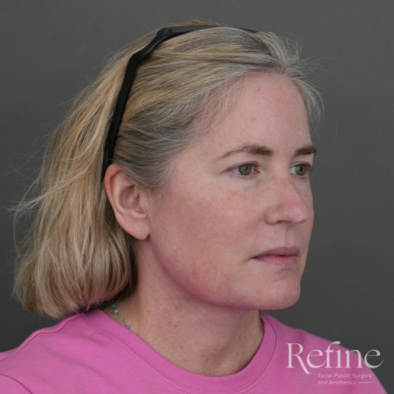 Deep Neck Lift Before & After Gallery - Patient 420466 - Image 4