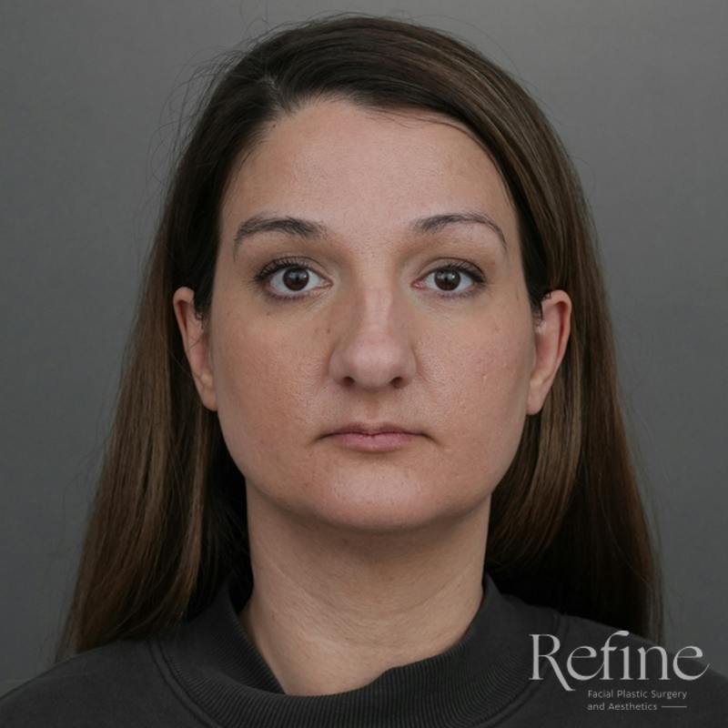 Rhinoplasty Before & After Gallery - Patient 200233 - Image 5