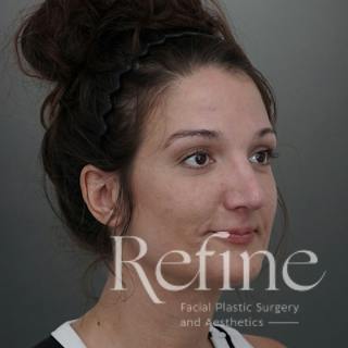 Rhinoplasty Before & After Gallery - Patient 200233 - Image 4