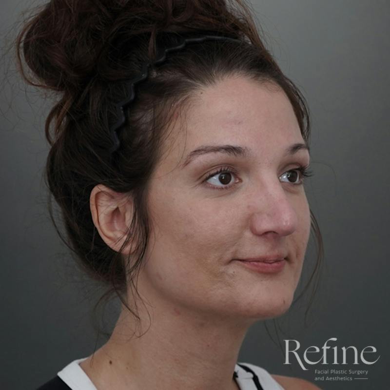 Rhinoplasty Before & After Gallery - Patient 200233 - Image 4