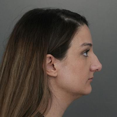 Rhinoplasty Before & After Gallery - Patient 200233 - Image 1