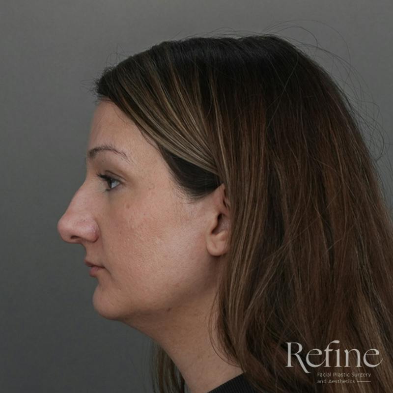 Rhinoplasty Before & After Gallery - Patient 200233 - Image 9