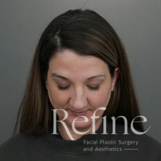 Rhinoplasty Before & After Gallery - Patient 200233 - Image 14