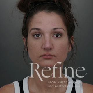 Rhinoplasty Before & After Gallery - Patient 200233 - Image 6