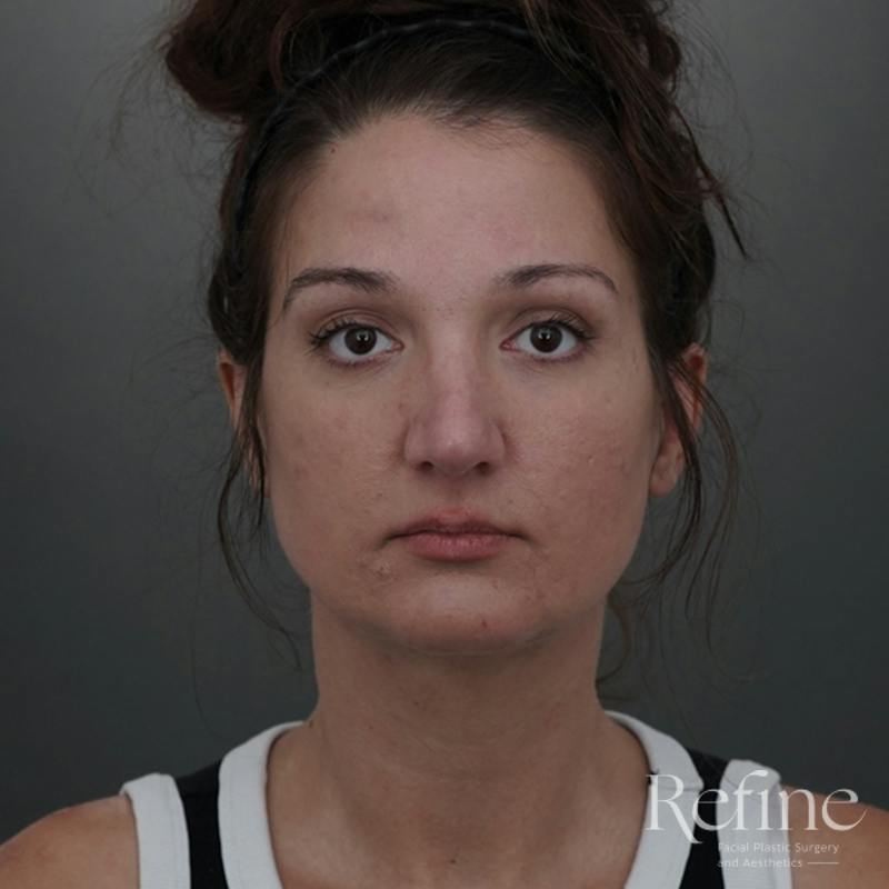 Rhinoplasty Before & After Gallery - Patient 200233 - Image 6