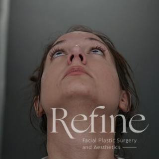 Rhinoplasty Before & After Gallery - Patient 200233 - Image 8