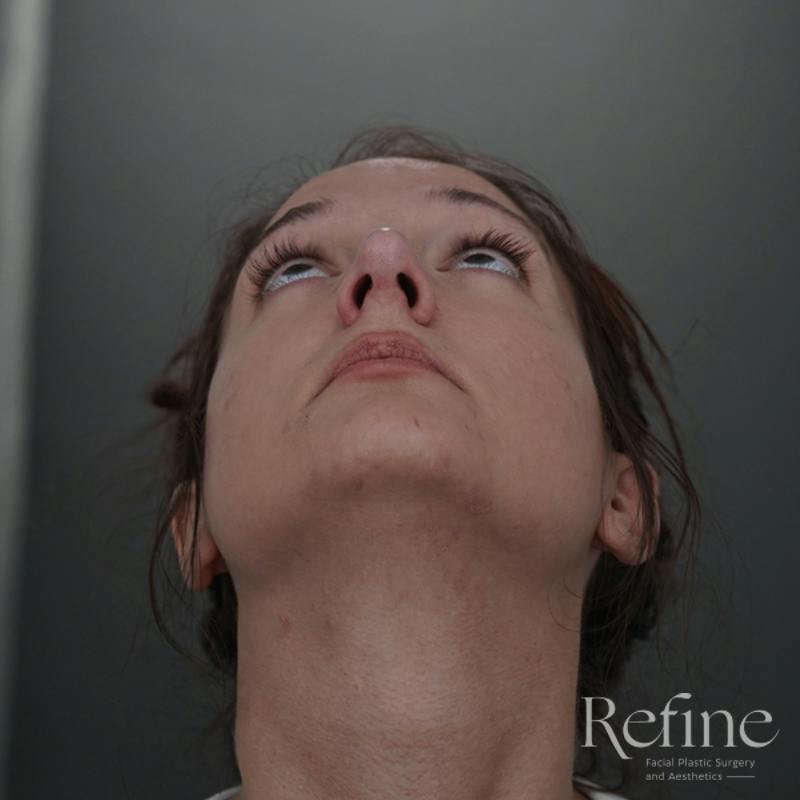 Rhinoplasty Before & After Gallery - Patient 200233 - Image 8