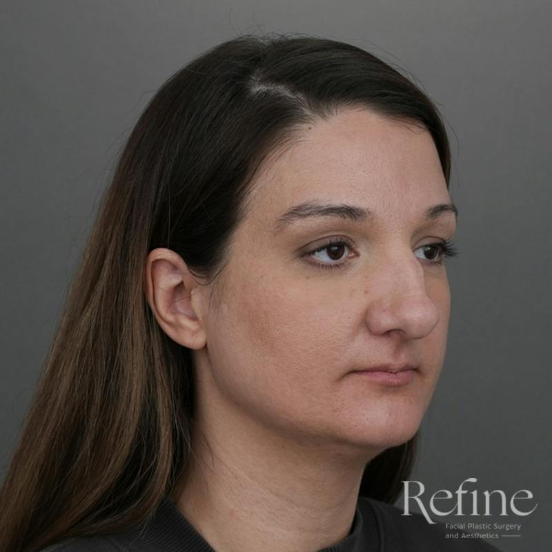 Rhinoplasty Before & After Gallery - Patient 200233 - Image 3