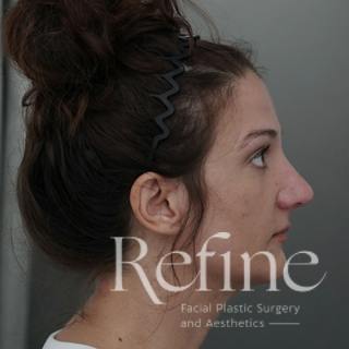 Rhinoplasty Before & After Gallery - Patient 200233 - Image 2