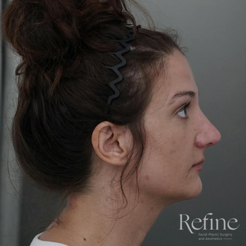 Rhinoplasty Before & After Gallery - Patient 200233 - Image 2