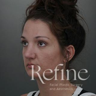 Rhinoplasty Before & After Gallery - Patient 200233 - Image 12