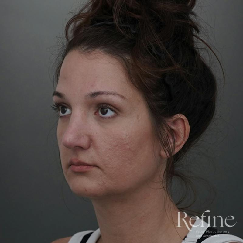 Rhinoplasty Before & After Gallery - Patient 200233 - Image 12