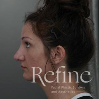 Rhinoplasty Before & After Gallery - Patient 200233 - Image 10