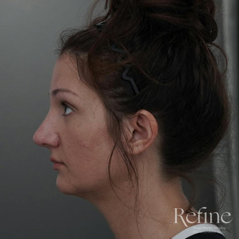 Rhinoplasty Before & After Gallery - Patient 200233 - Image 10