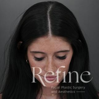 Rhinoplasty Before & After Gallery - Patient 244241 - Image 10