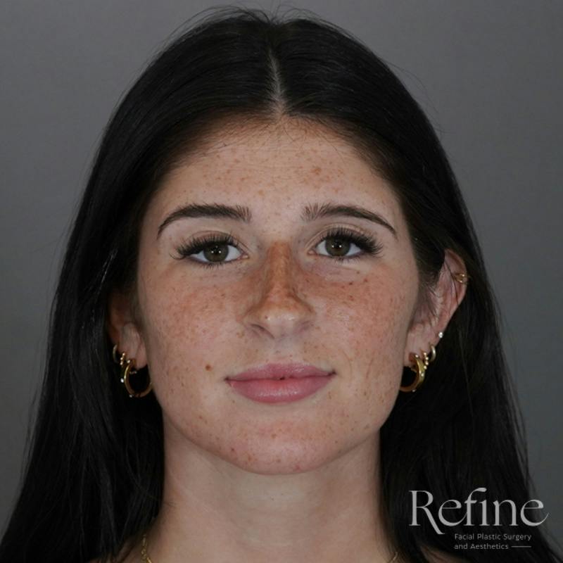 Rhinoplasty Before & After Gallery - Patient 244241 - Image 5
