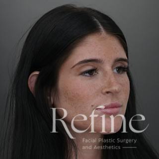 Rhinoplasty Before & After Gallery - Patient 244241 - Image 4