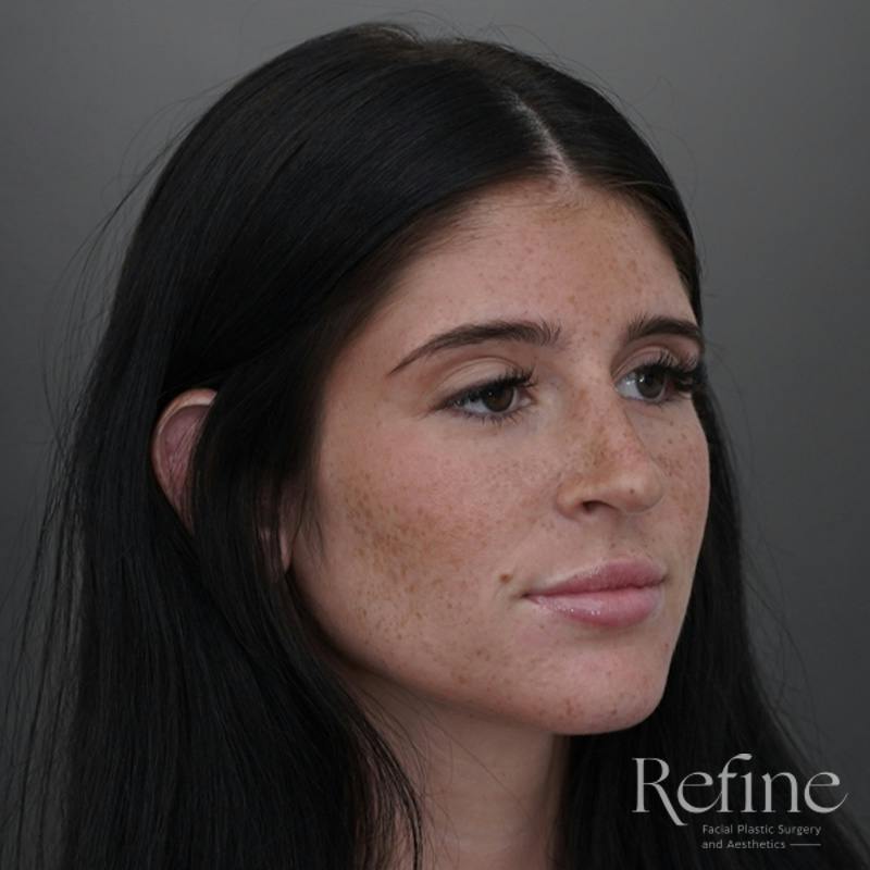 Rhinoplasty Before & After Gallery - Patient 244241 - Image 4
