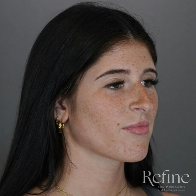 Rhinoplasty Before & After Gallery - Patient 244241 - Image 3