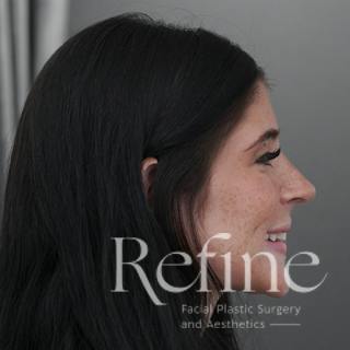 Rhinoplasty Before & After Gallery - Patient 244241 - Image 2