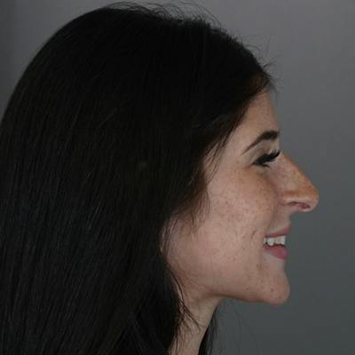 Rhinoplasty Before & After Gallery - Patient 244241 - Image 1