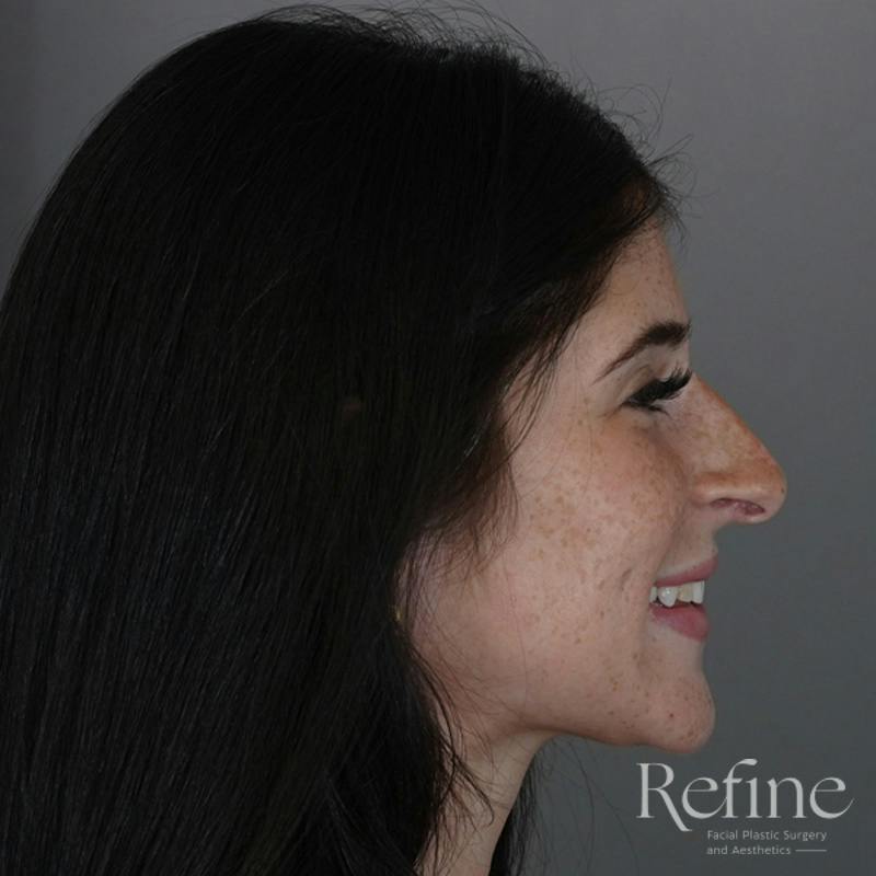 Rhinoplasty Before & After Gallery - Patient 244241 - Image 1