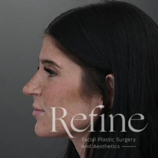 Rhinoplasty Before & After Gallery - Patient 244241 - Image 14