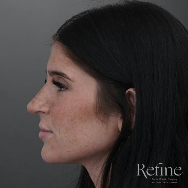Rhinoplasty Before & After Gallery - Patient 244241 - Image 14