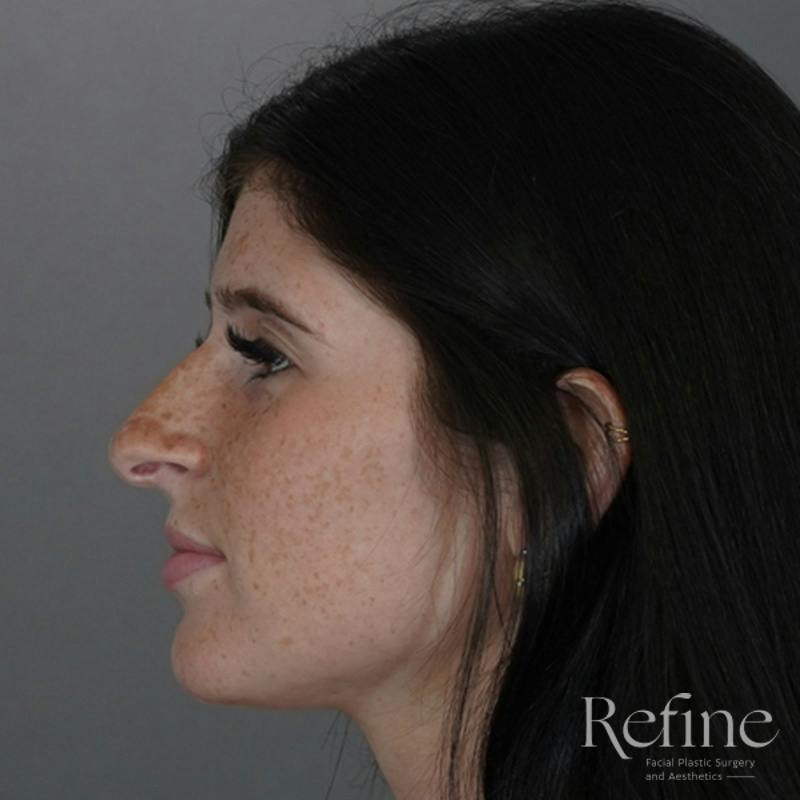 Rhinoplasty Before & After Gallery - Patient 244241 - Image 13