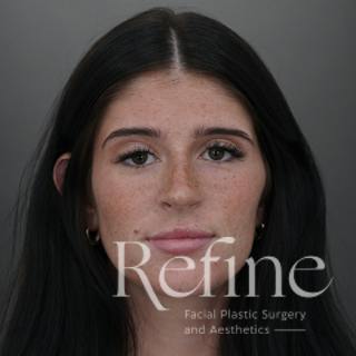 Rhinoplasty Before & After Gallery - Patient 244241 - Image 6