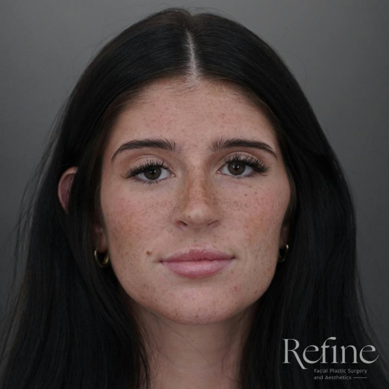 Rhinoplasty Before & After Gallery - Patient 244241 - Image 6