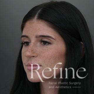 Rhinoplasty Before & After Gallery - Patient 244241 - Image 12