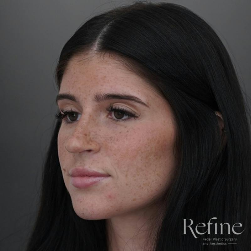 Rhinoplasty Before & After Gallery - Patient 244241 - Image 12