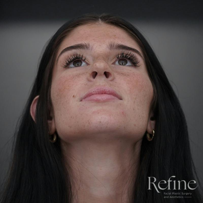 Rhinoplasty Before & After Gallery - Patient 244241 - Image 8