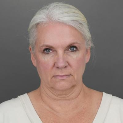 Brow Lift Before & After Gallery - Patient 301782 - Image 1