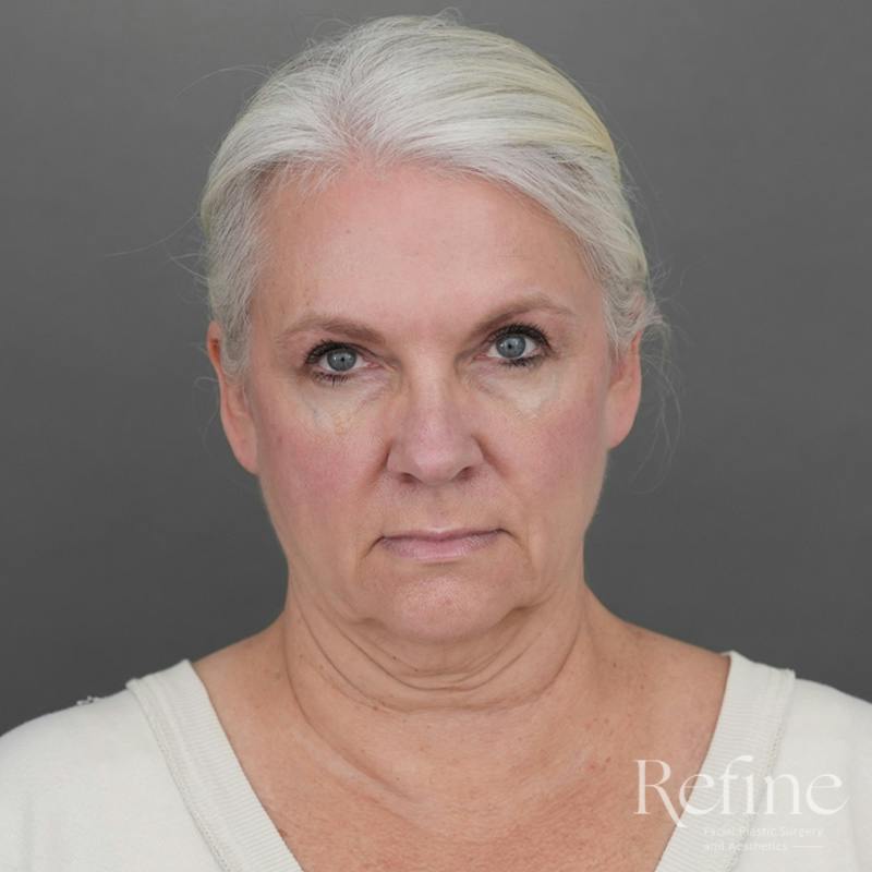 Deep Plane Facelift Before & After Gallery - Patient 137834 - Image 5