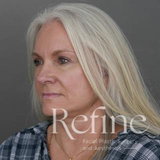 Deep Plane Facelift Before & After Gallery - Patient 137834 - Image 8