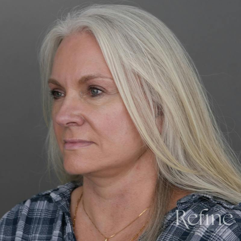 Deep Plane Facelift Before & After Gallery - Patient 137834 - Image 8
