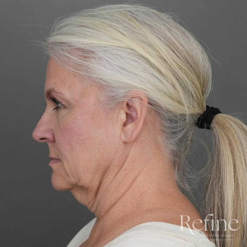 Deep Plane Facelift Before & After Gallery - Patient 137834 - Image 9