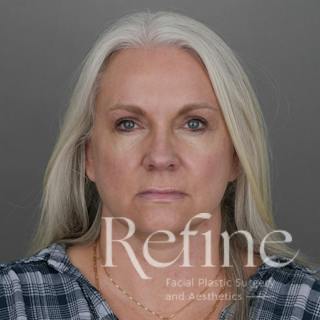 Deep Plane Facelift Before & After Gallery - Patient 137834 - Image 6