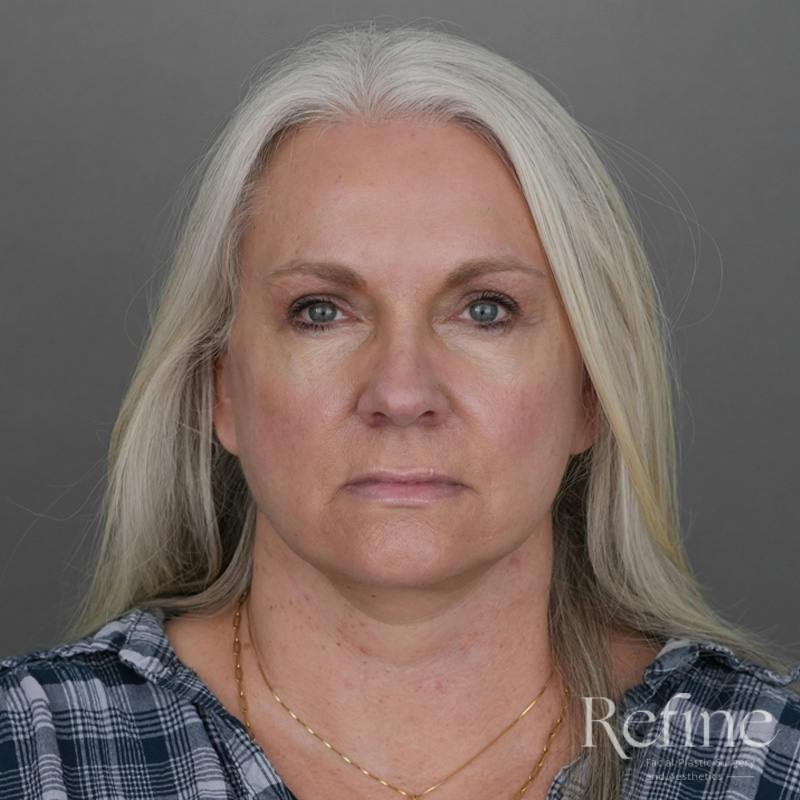 Deep Plane Facelift Before & After Gallery - Patient 137834 - Image 6